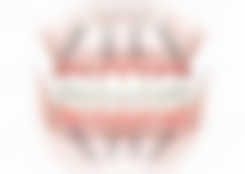 价格方面：奥齿泰TSSA种植牙贵吗？