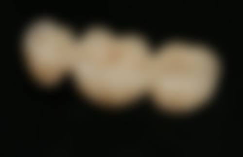 临床实例分享北京美冠塔口腔连锁(朝阳路分院)黄晓雷