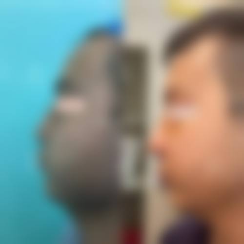 临床实例分享徐州懿薇莱美容李志敏