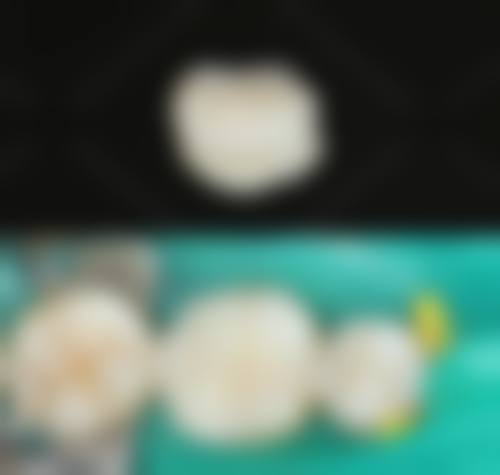 临床实例分享北京佳美口腔(三元桥店)刘继乐
