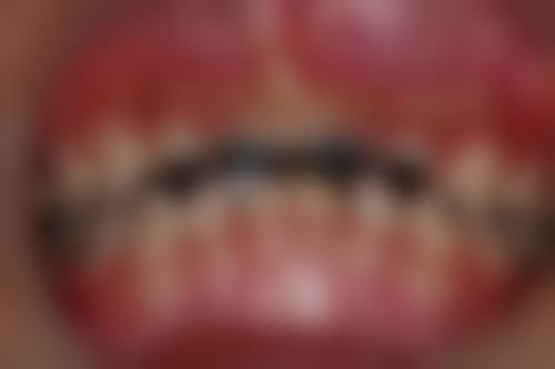 临床实例分享沈阳宁静口腔门诊部孙尚敏