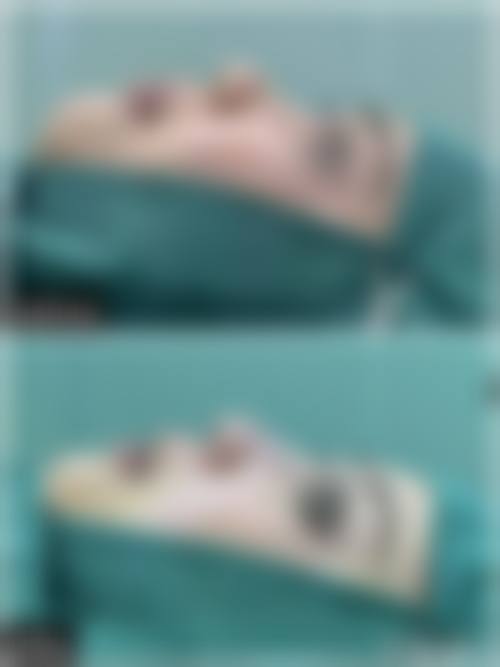 临床实例分享福州新世纪整形医院陈志明