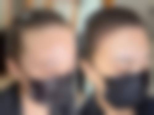 诊疗特色总结沈阳毛发移植及再生研究中 心