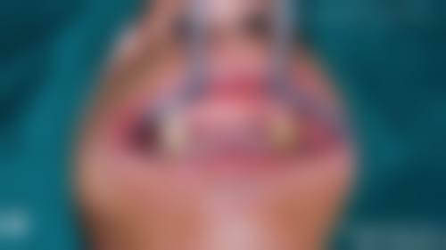 临床实例分享青岛雅康口腔诊所